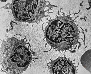 M,81y. | blood - hairy cell leukemia M,81y. | blood - hairy cell leukemia